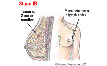 Breast Stage IB.jpg